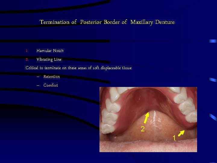 Termination of Posterior Border of Maxillary Denture 1. Hamular Notch 2. Vibrating Line Critical Termination of Posterior Border of Maxillary Denture 1. Hamular Notch 2. Vibrating Line Critical