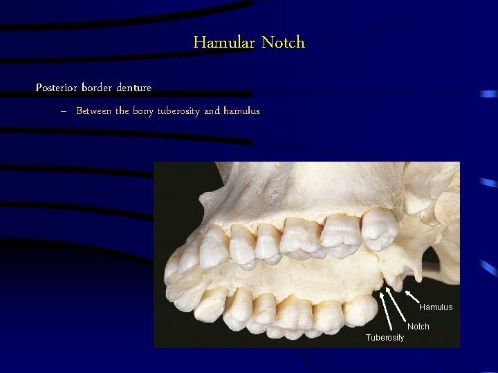 Hamular Notch Posterior border denture – Between the bony tuberosity and hamulus Hamulus Notch Hamular Notch Posterior border denture – Between the bony tuberosity and hamulus Hamulus Notch