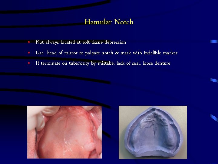 Hamular Notch • Not always located at soft tissue depression • Use head of