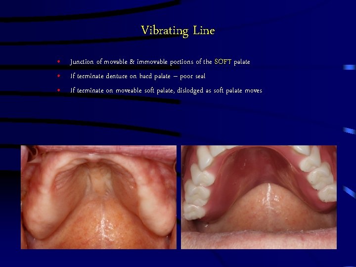 Vibrating Line • Junction of movable & immovable portions of the SOFT palate •