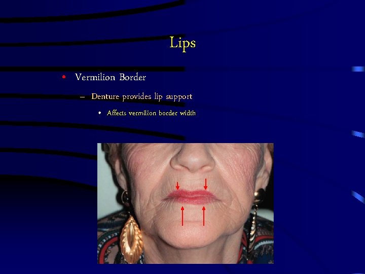 Lips • Vermilion Border – Denture provides lip support • Affects vermilion border width