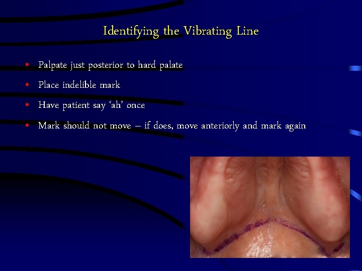 Identifying the Vibrating Line • • Palpate just posterior to hard palate Place indelible