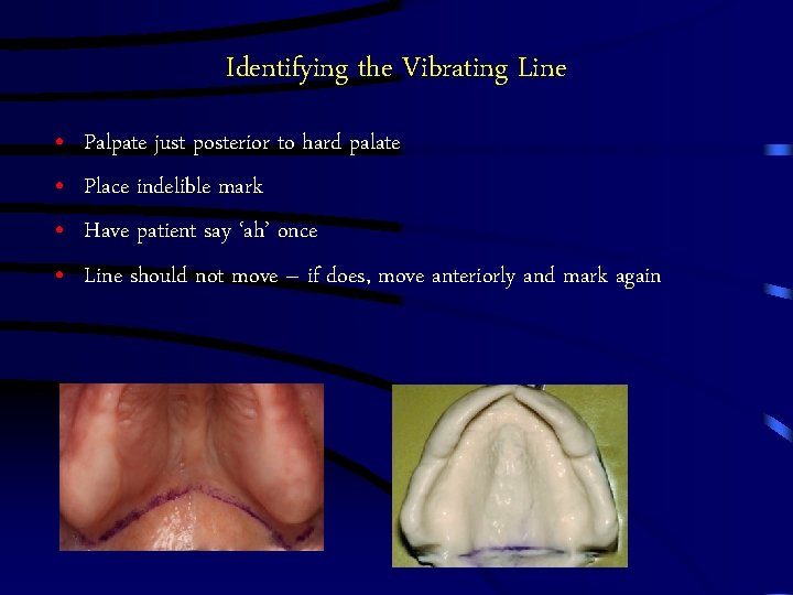 Identifying the Vibrating Line • • Palpate just posterior to hard palate Place indelible