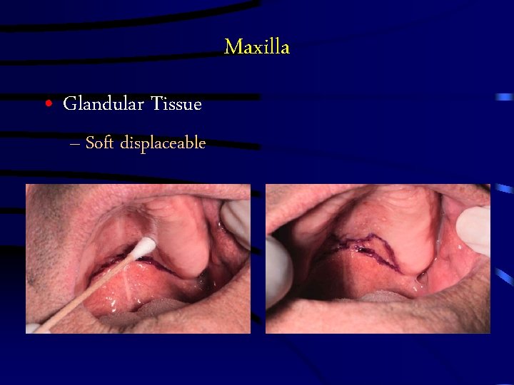 Maxilla • Glandular Tissue – Soft displaceable Maxilla • Glandular Tissue – Soft displaceable