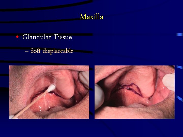 Maxilla • Glandular Tissue – Soft displaceable 