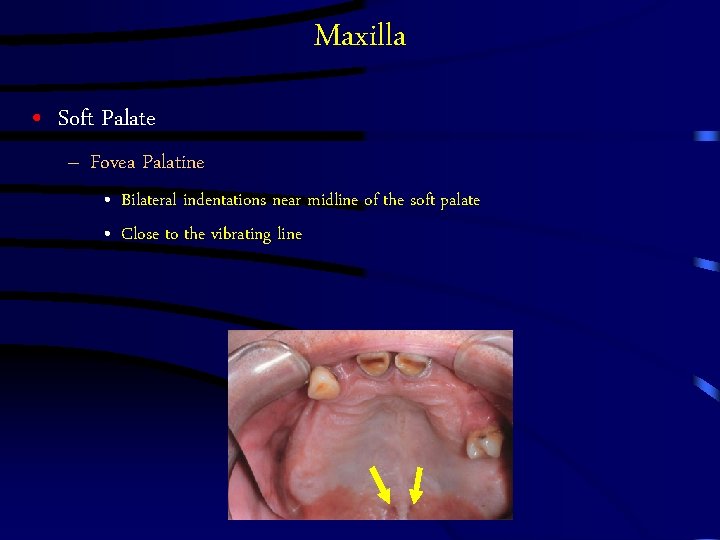 Maxilla • Soft Palate – Fovea Palatine • Bilateral indentations near midline of the Maxilla • Soft Palate – Fovea Palatine • Bilateral indentations near midline of the