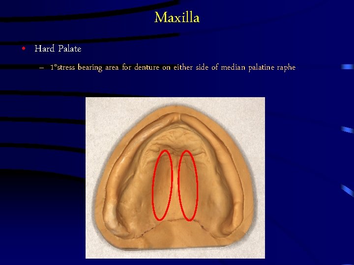Maxilla • Hard Palate – 1°stress bearing area for denture on either side of Maxilla • Hard Palate – 1°stress bearing area for denture on either side of