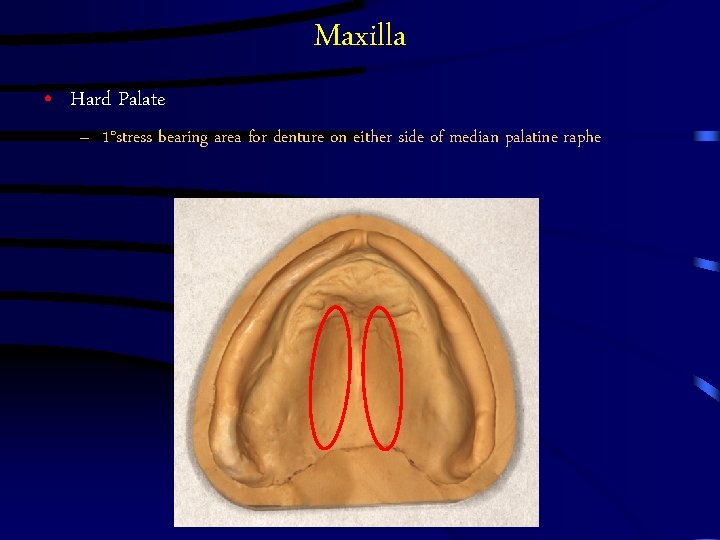 Maxilla • Hard Palate – 1°stress bearing area for denture on either side of