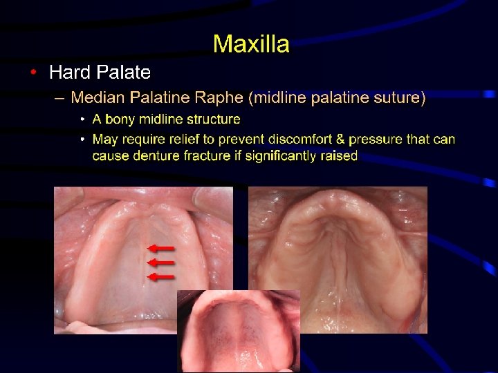  • Hard Palate Maxilla – Median Palatine Raphe (midline palatine suture) • A