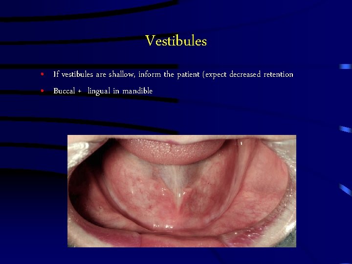 Vestibules • If vestibules are shallow, inform the patient (expect decreased retention • Buccal