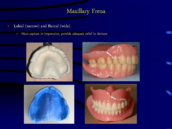 Maxillary Frena • Labial (narrow) and Buccal (wide) – Must capture in impression, provide Maxillary Frena • Labial (narrow) and Buccal (wide) – Must capture in impression, provide
