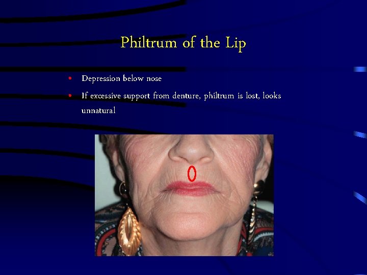 Philtrum of the Lip • Depression below nose • If excessive support from denture,