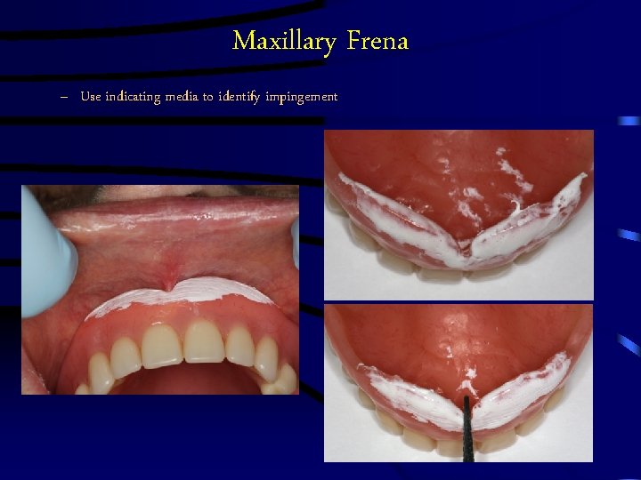 Maxillary Frena – Use indicating media to identify impingement Labial Maxillary Frena – Use indicating media to identify impingement Labial