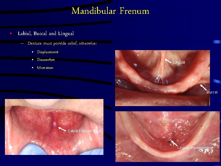 Mandibular Frenum • Labial, Buccal and Lingual – Denture must provide relief, otherwise: •