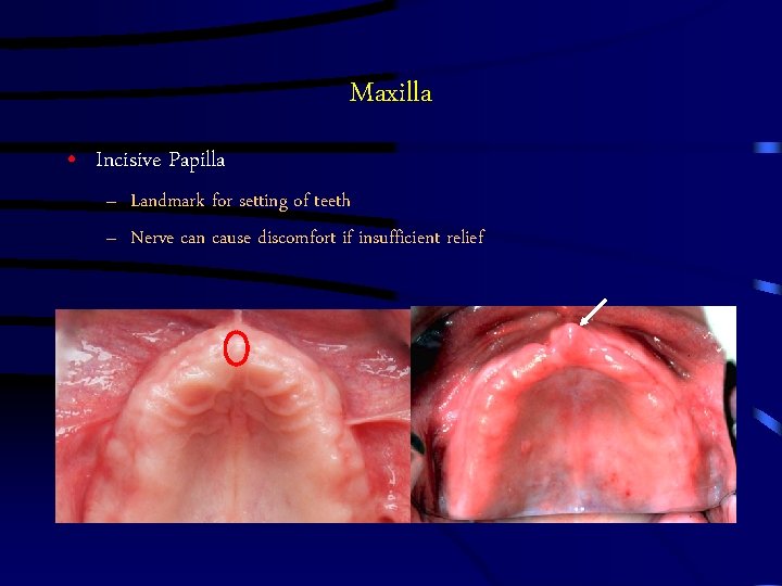 Maxilla • Incisive Papilla – Landmark for setting of teeth – Nerve can cause