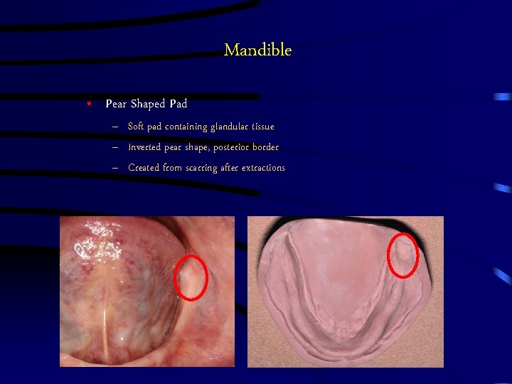 Mandible • Pear Shaped Pad – Soft pad containing glandular tissue – Inverted pear Mandible • Pear Shaped Pad – Soft pad containing glandular tissue – Inverted pear
