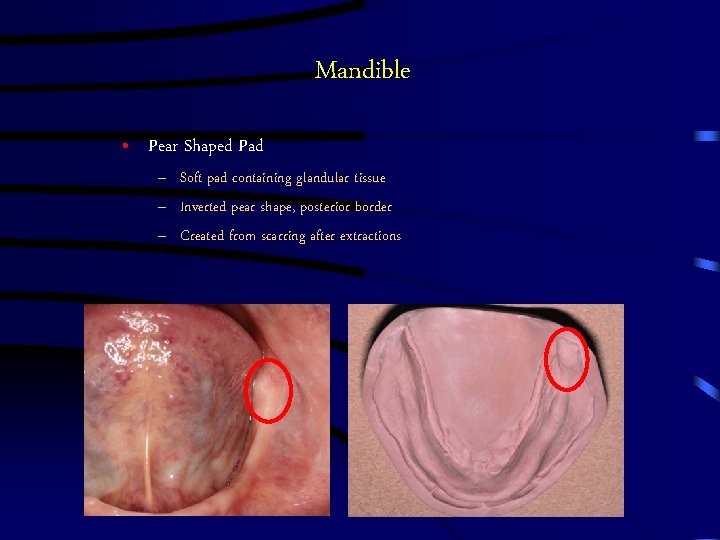 Mandible • Pear Shaped Pad – Soft pad containing glandular tissue – Inverted pear