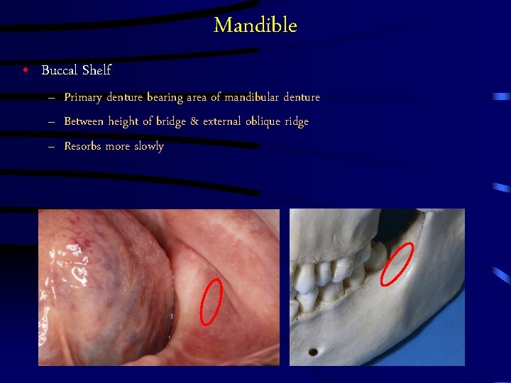 Mandible • Buccal Shelf – Primary denture bearing area of mandibular denture – Between