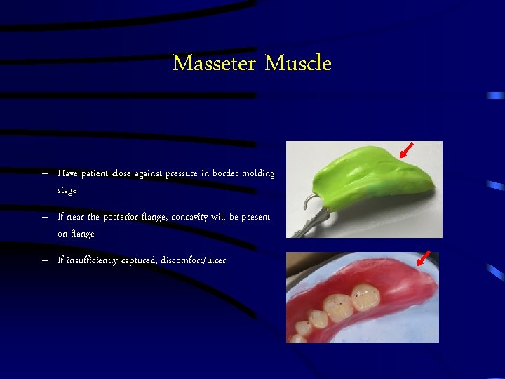 Masseter Muscle – Have patient close against pressure in border molding stage – If Masseter Muscle – Have patient close against pressure in border molding stage – If