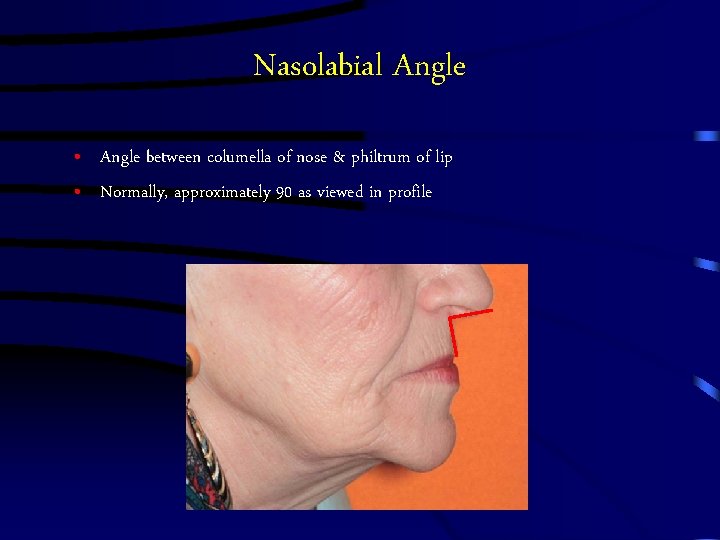 Nasolabial Angle • Angle between columella of nose & philtrum of lip • Normally,