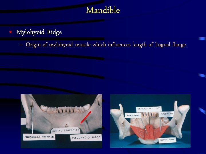 Mandible • Mylohyoid Ridge – Origin of mylohyoid muscle which influences length of lingual