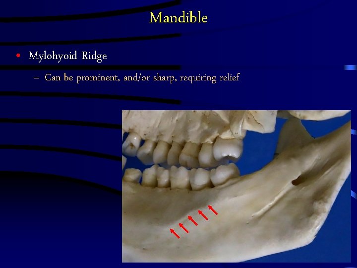 Mandible • Mylohyoid Ridge – Can be prominent, and/or sharp, requiring relief Mandible • Mylohyoid Ridge – Can be prominent, and/or sharp, requiring relief