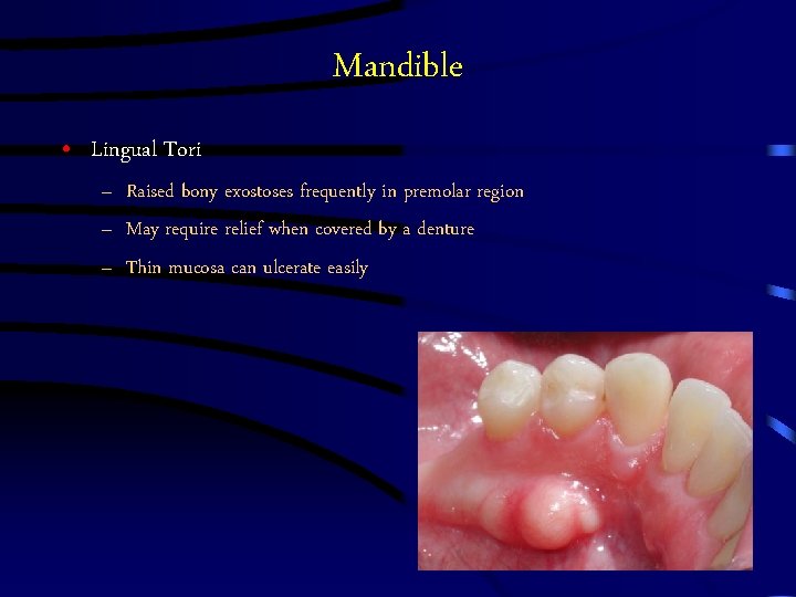 Mandible • Lingual Tori – Raised bony exostoses frequently in premolar region – May Mandible • Lingual Tori – Raised bony exostoses frequently in premolar region – May