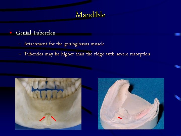 Mandible • Genial Tubercles – Attachment for the genioglossus muscle – Tubercles may be