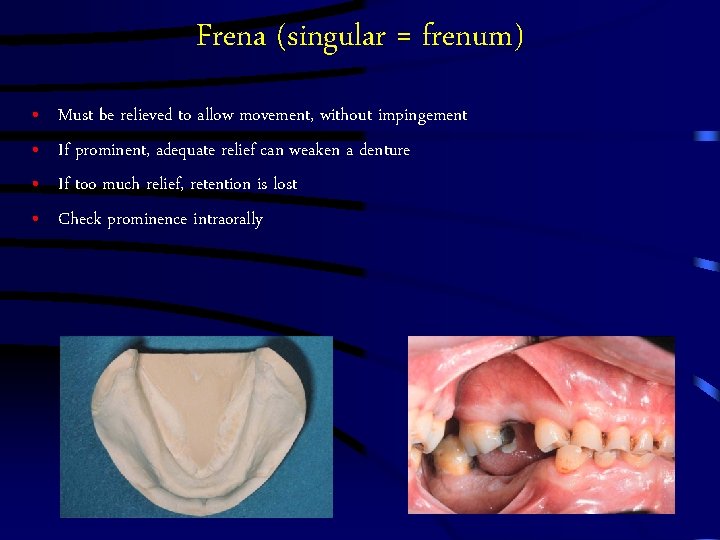 Frena (singular = frenum) • • Must be relieved to allow movement, without impingement