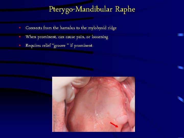 Pterygo-Mandibular Raphe • Connects from the hamulus to the mylohyoid ridge • When prominent, Pterygo-Mandibular Raphe • Connects from the hamulus to the mylohyoid ridge • When prominent,