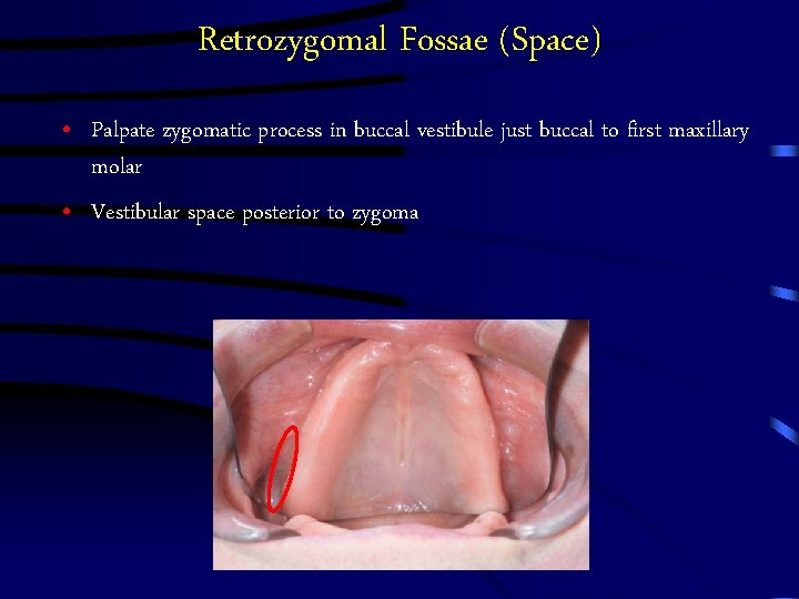 Retrozygomal Fossae (Space) • Palpate zygomatic process in buccal vestibule just buccal to first Retrozygomal Fossae (Space) • Palpate zygomatic process in buccal vestibule just buccal to first