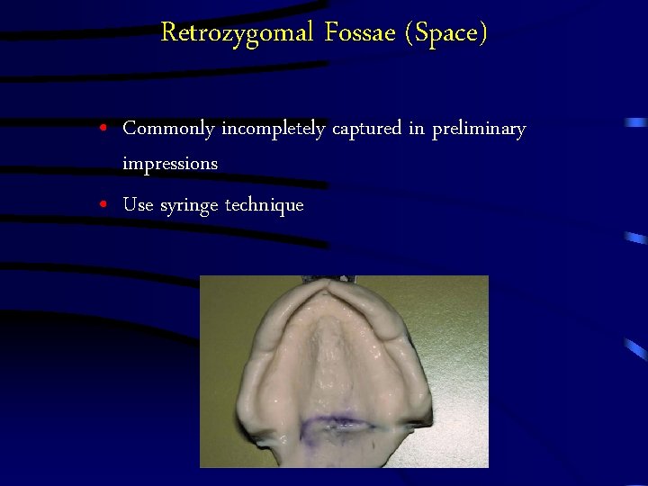 Retrozygomal Fossae (Space) • Commonly incompletely captured in preliminary impressions • Use syringe technique Retrozygomal Fossae (Space) • Commonly incompletely captured in preliminary impressions • Use syringe technique