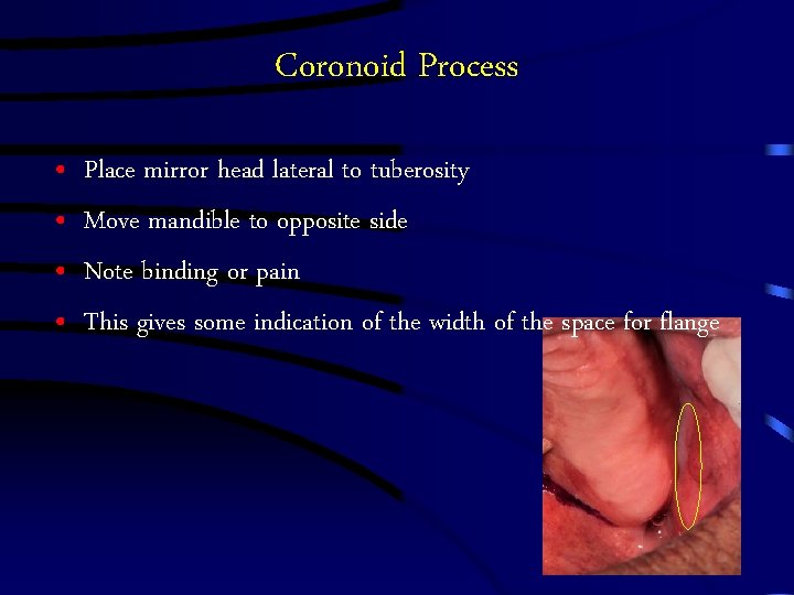 Coronoid Process • • Place mirror head lateral to tuberosity Move mandible to opposite Coronoid Process • • Place mirror head lateral to tuberosity Move mandible to opposite