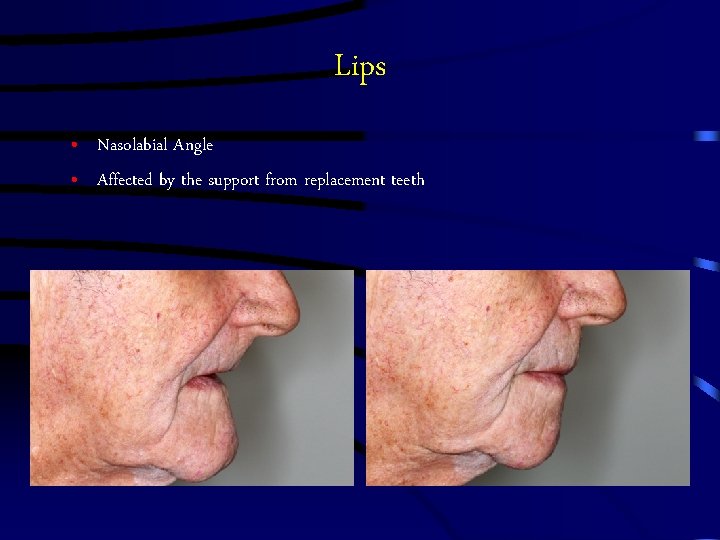 Lips • Nasolabial Angle • Affected by the support from replacement teeth 