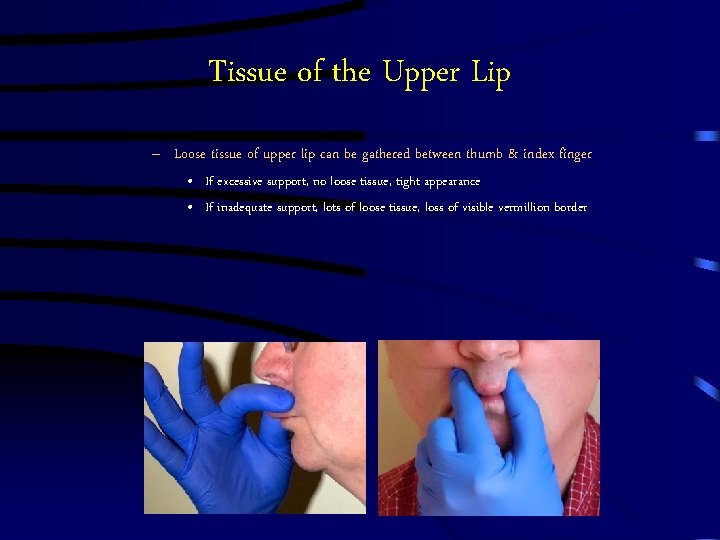 Tissue of the Upper Lip – Loose tissue of upper lip can be gathered Tissue of the Upper Lip – Loose tissue of upper lip can be gathered