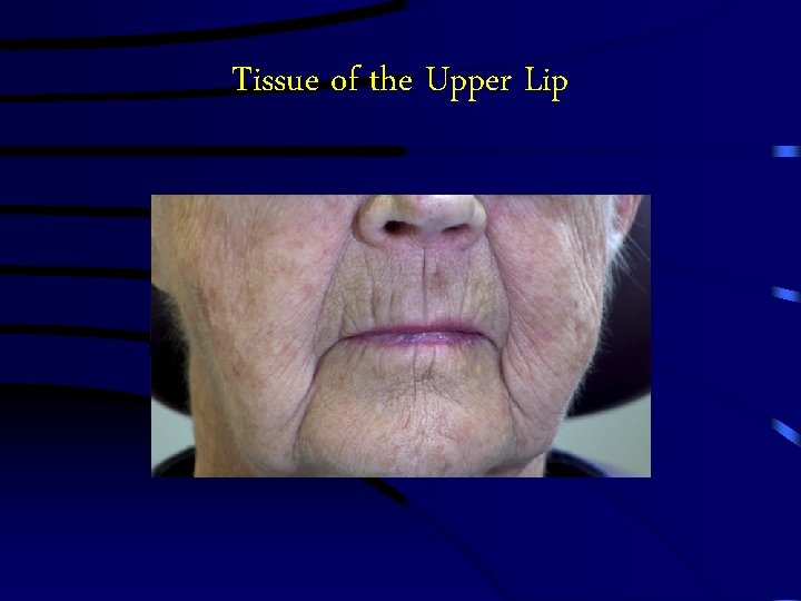 Tissue of the Upper Lip Tissue of the Upper Lip