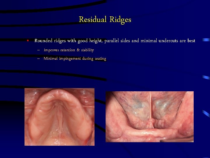 Residual Ridges • Rounded ridges with good height, parallel sides and minimal undercuts are