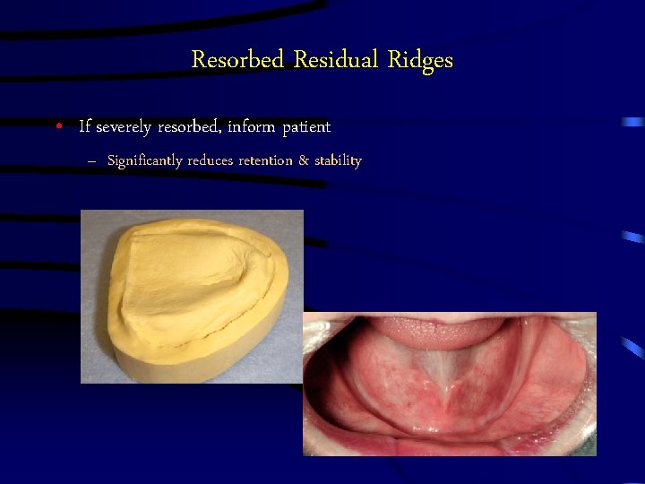 Resorbed Residual Ridges • If severely resorbed, inform patient – Significantly reduces retention &