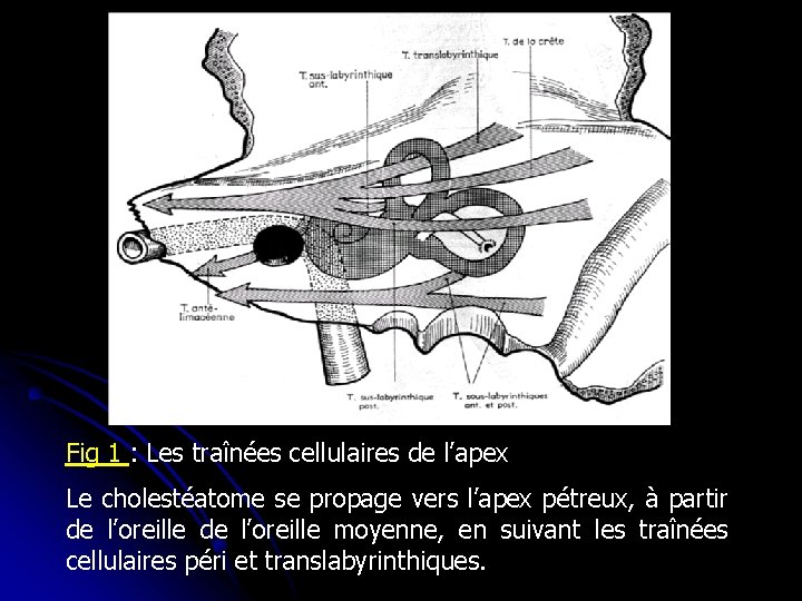 Fig 1 : Les traînées cellulaires de l’apex Le cholestéatome se propage vers l’apex