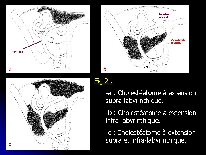 Ganglion géniculé A. Carotide interne Nerf facial a b VJI Fig 2 : -a