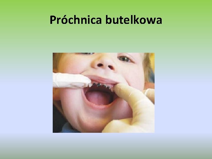 Próchnica butelkowa 