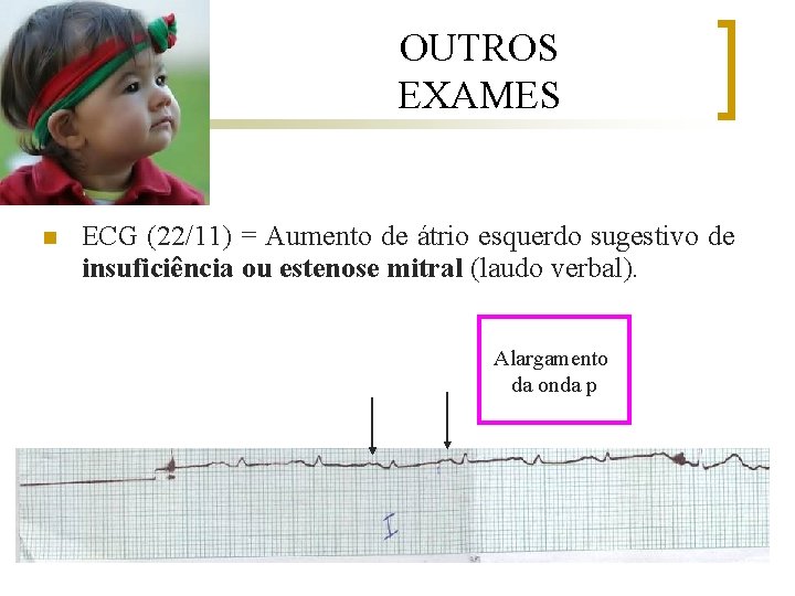 OUTROS EXAMES n ECG (22/11) = Aumento de átrio esquerdo sugestivo de insuficiência ou