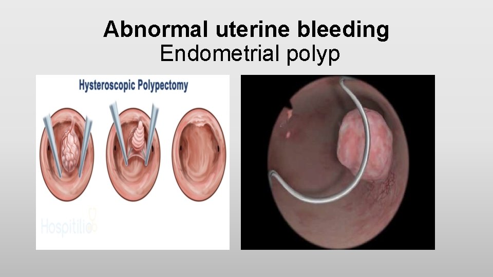 Abnormal uterine bleeding Endometrial polyp 