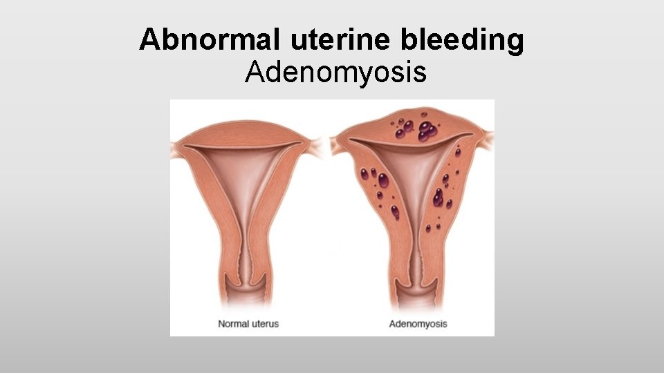 Abnormal uterine bleeding Adenomyosis 