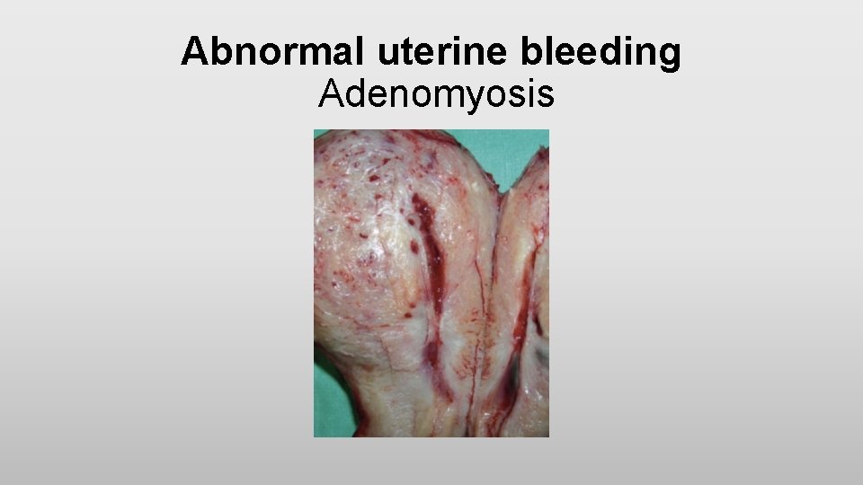Abnormal uterine bleeding Adenomyosis 