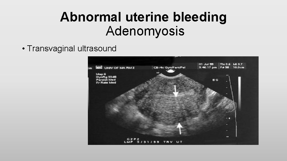 Abnormal uterine bleeding Adenomyosis • Transvaginal ultrasound 