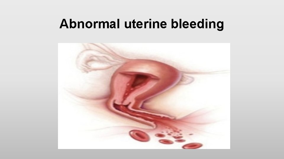 Abnormal uterine bleeding 