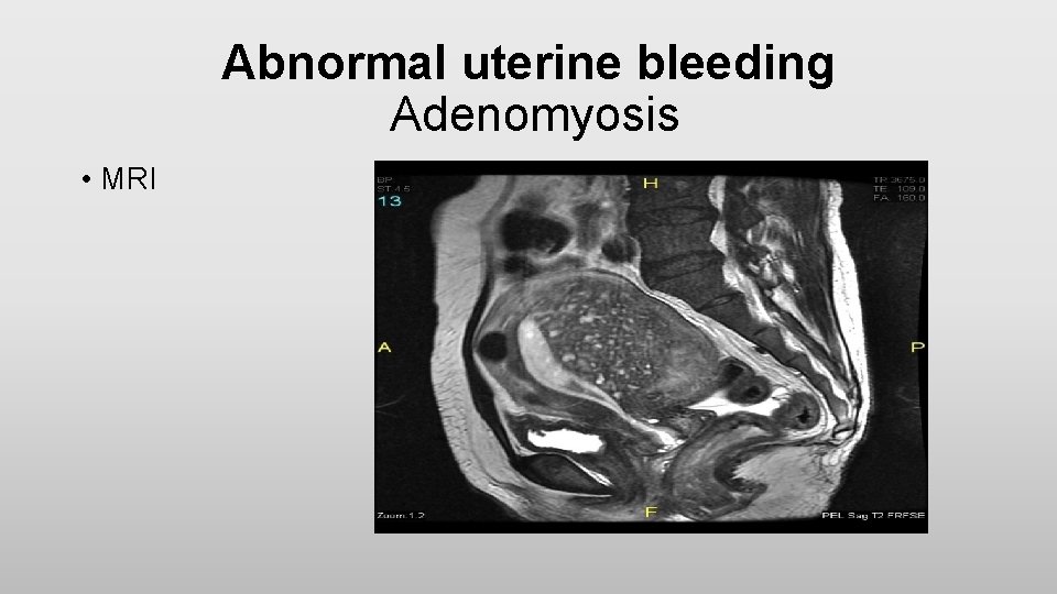 Abnormal uterine bleeding Adenomyosis • MRI 