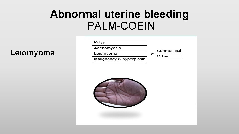 Abnormal uterine bleeding PALM-COEIN Leiomyoma 