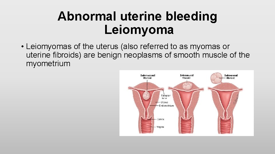 Abnormal uterine bleeding Leiomyoma • Leiomyomas of the uterus (also referred to as myomas